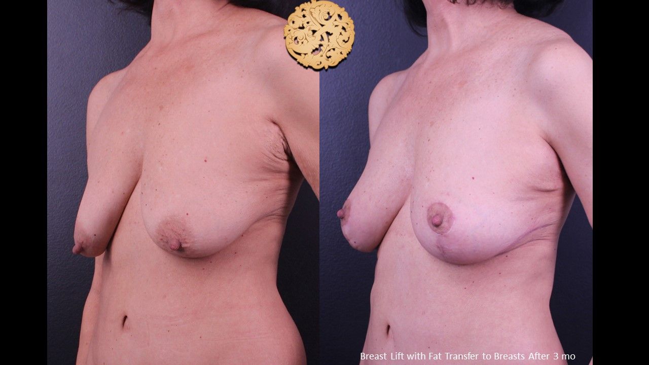 Breast Lift Before & After