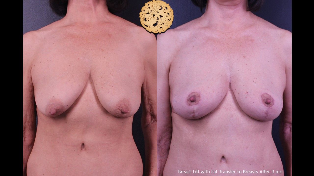 Breast Lift Before & After