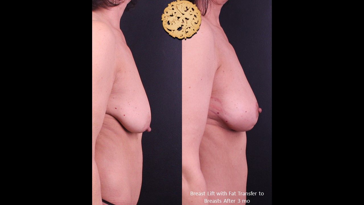 Breast Lift Before & After