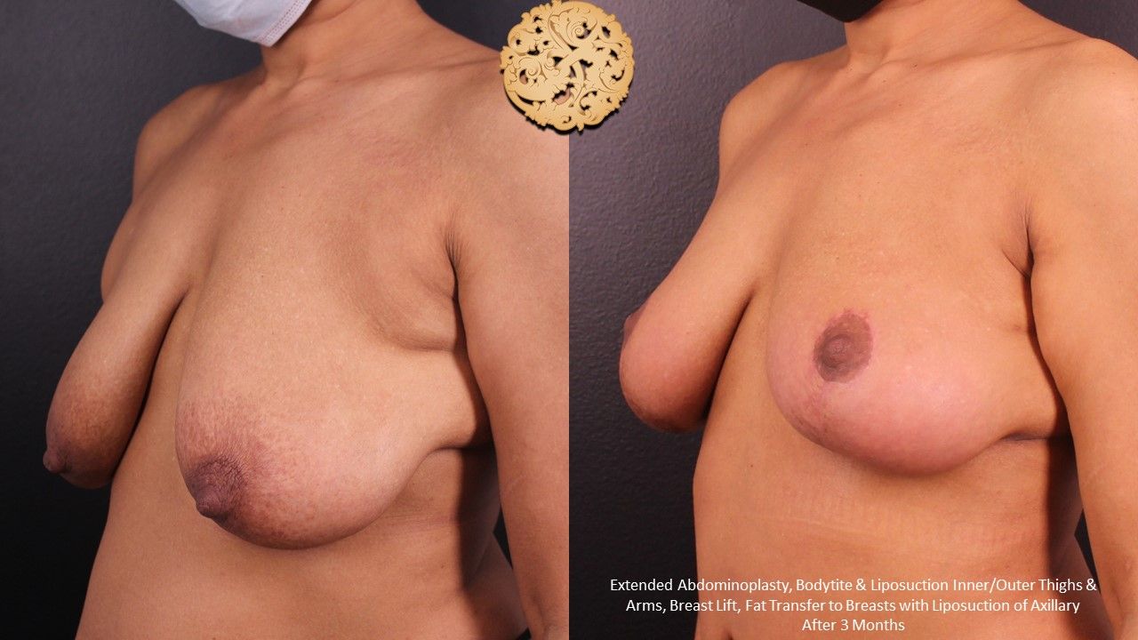 Breast Lift Before & After