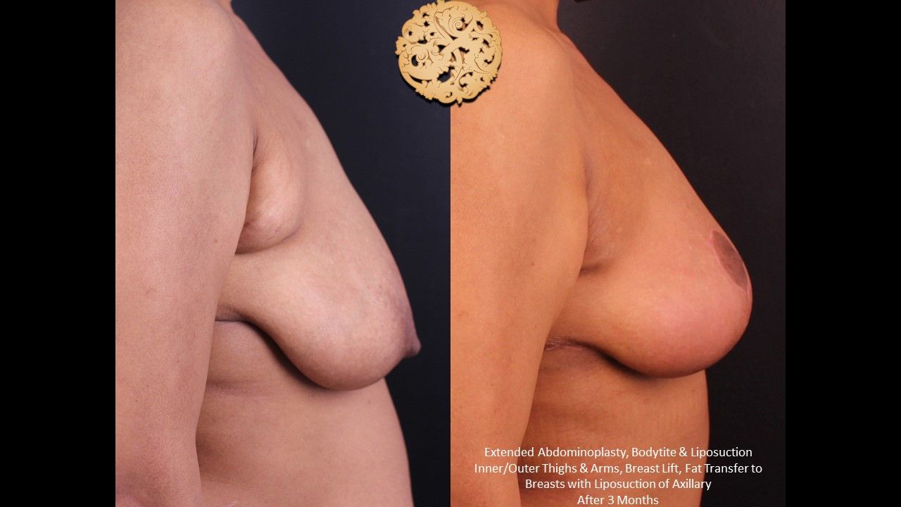 Breast Lift Before & After
