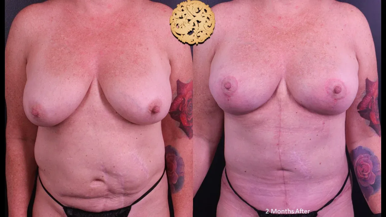 Breast Lift Before & After