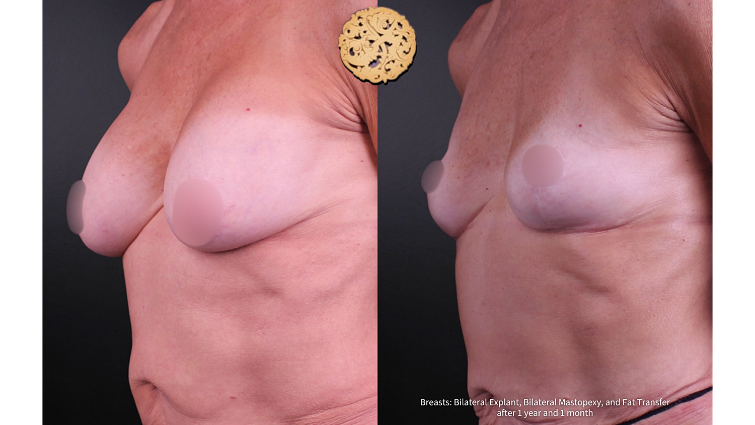 Breast Lift Before & After