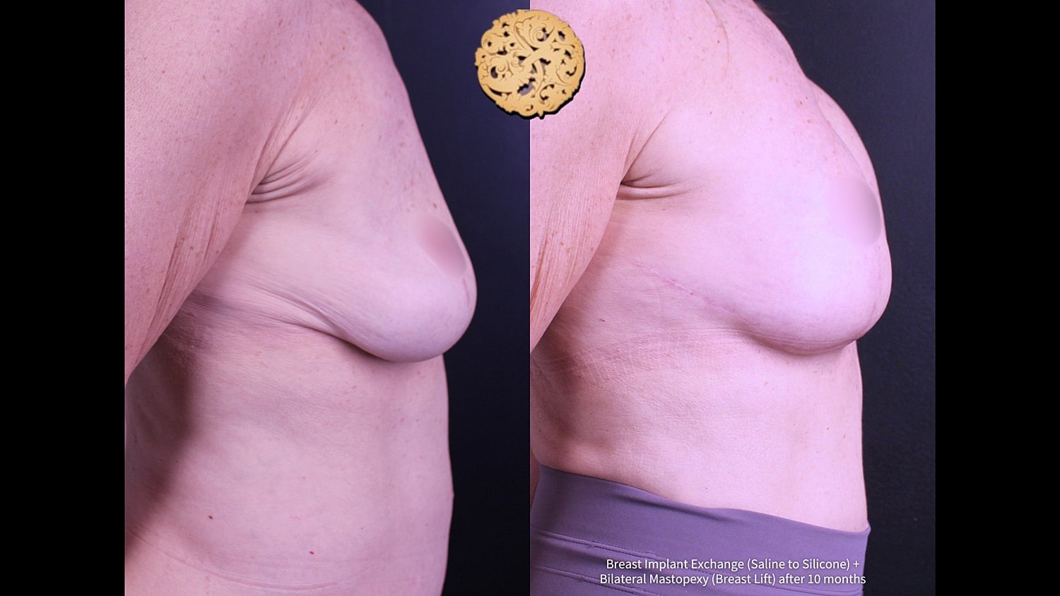 Before and after breast surgery comparison photo.