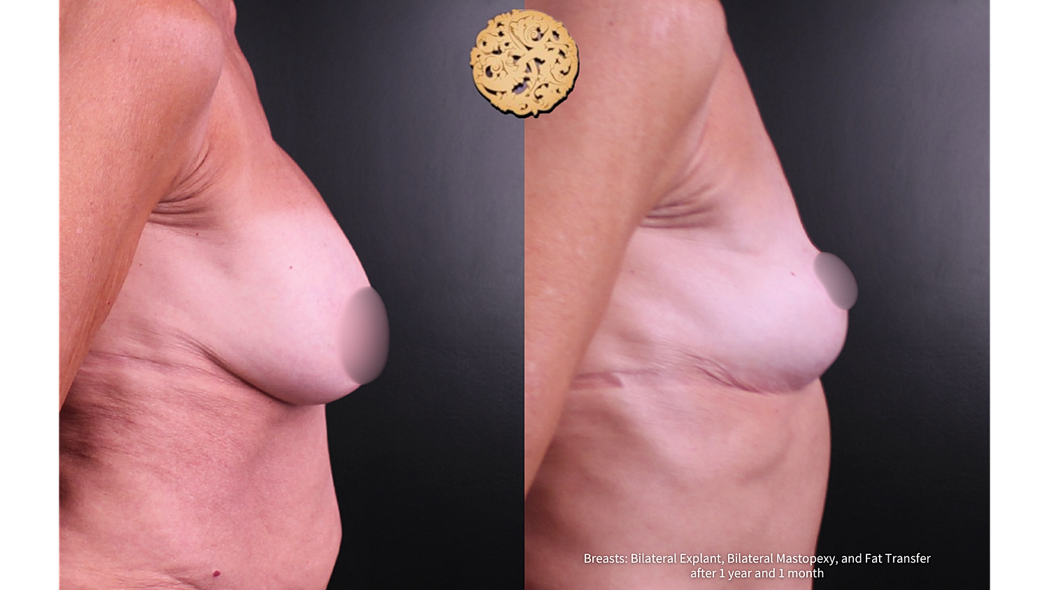 Breast Lift Before & After
