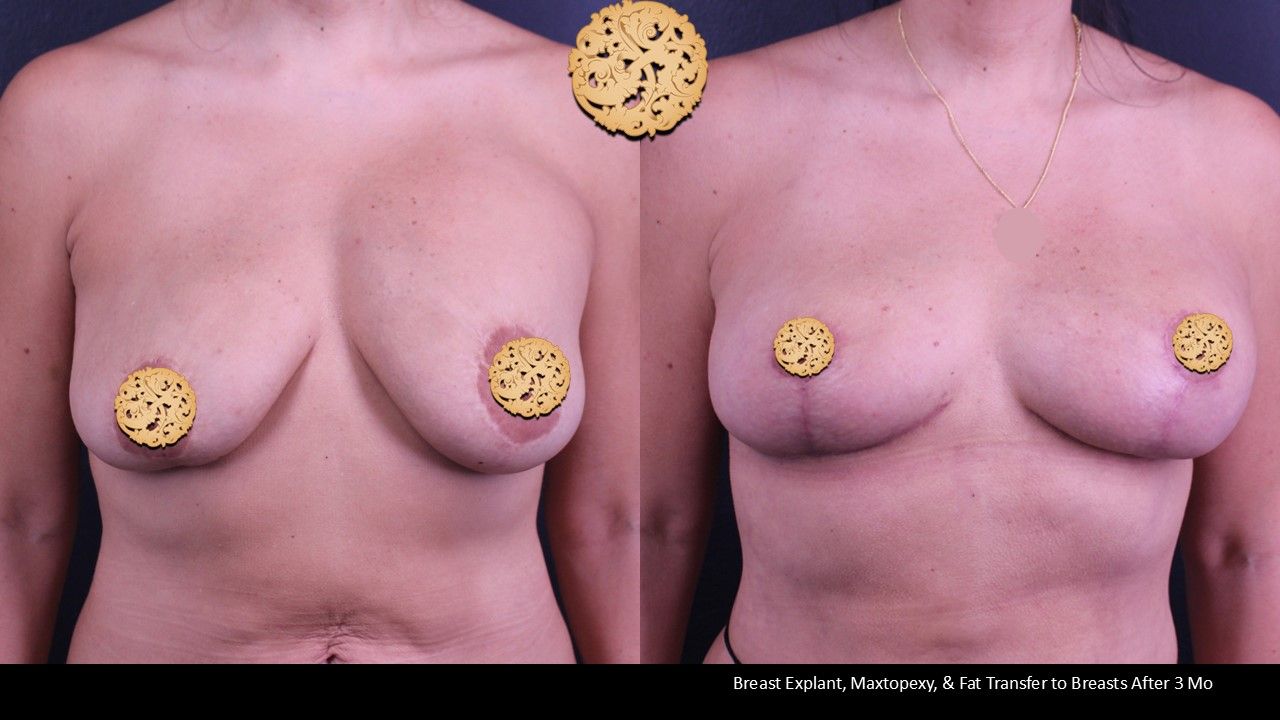 Breast Lift Before & After