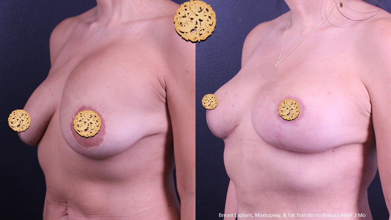 Breast Lift Before & After