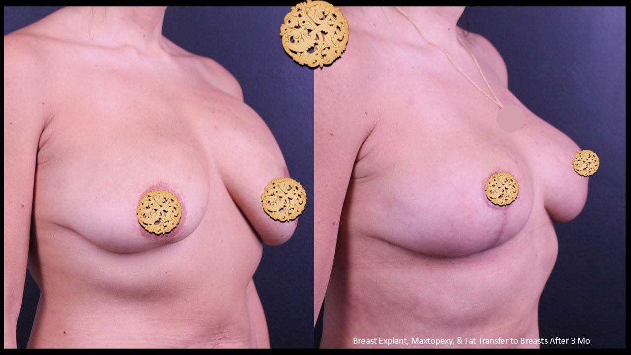 Breast Lift Before & After