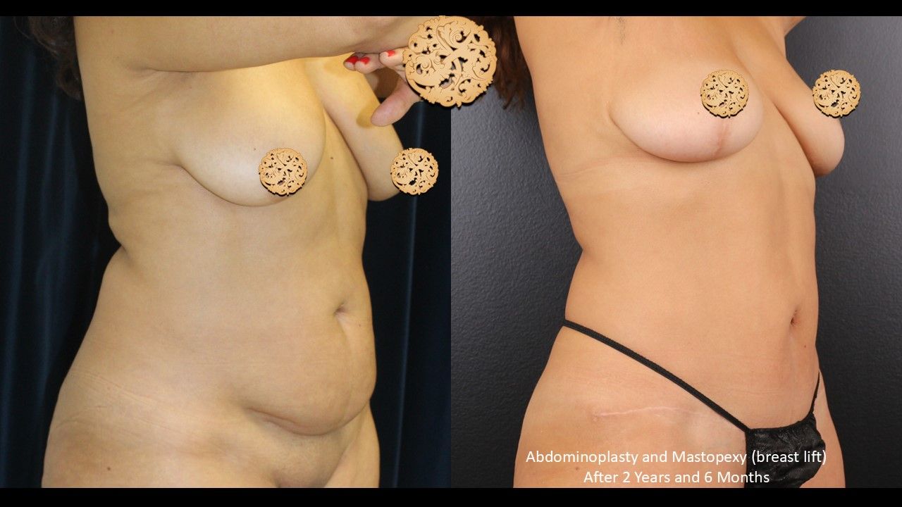 Breast Lift Before & After