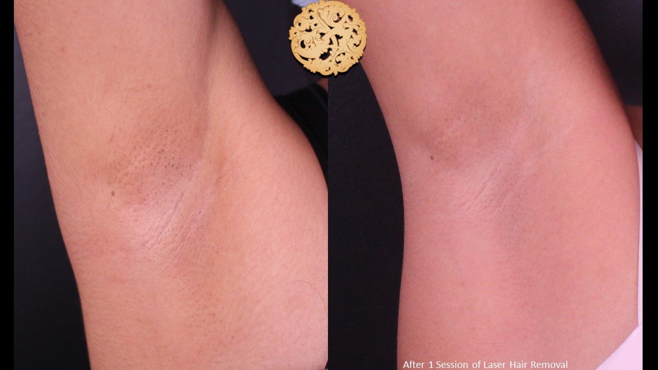 Laser Hair Removal Before & After