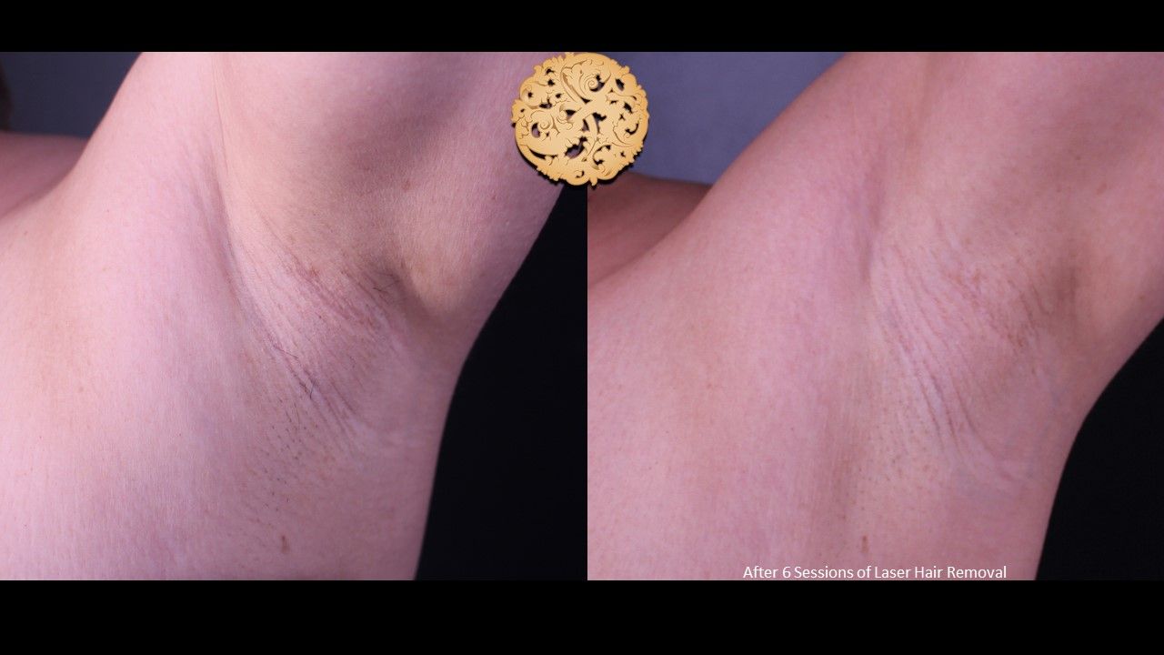 Laser Hair Removal Before & After