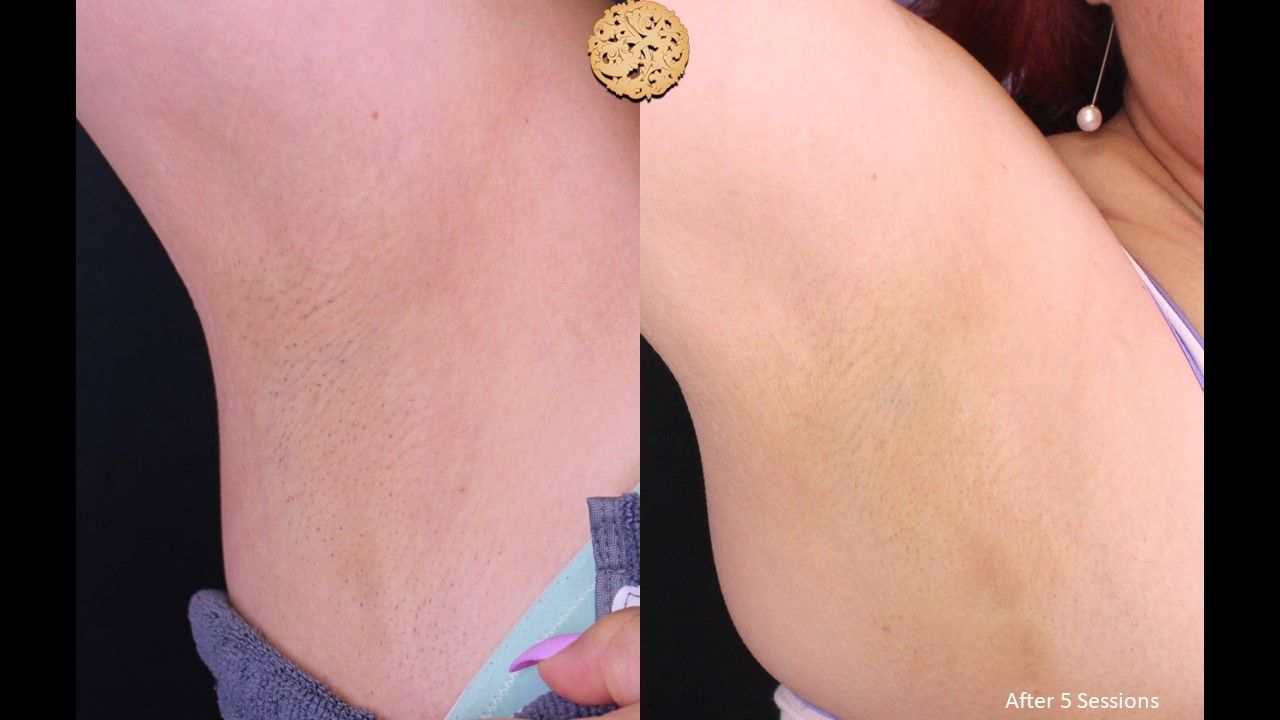 Laser Hair Removal Before & After