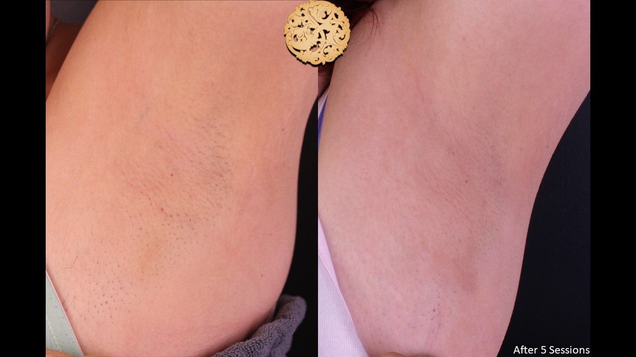 Laser Hair Removal Before & After