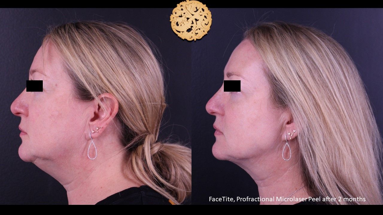 Facetite Before & After