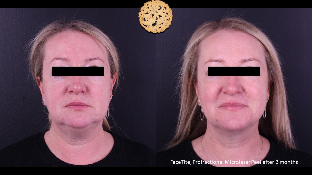 Facetite Before & After