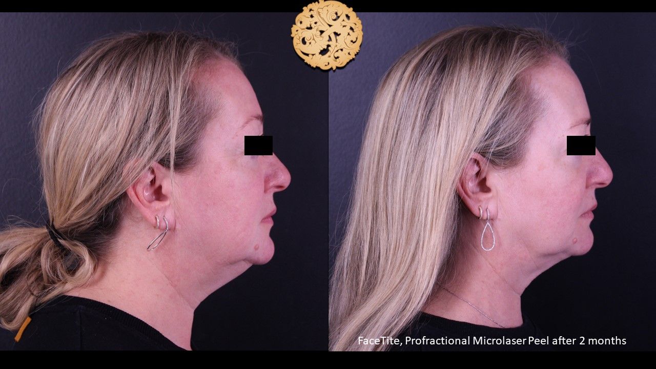 Facetite Before & After