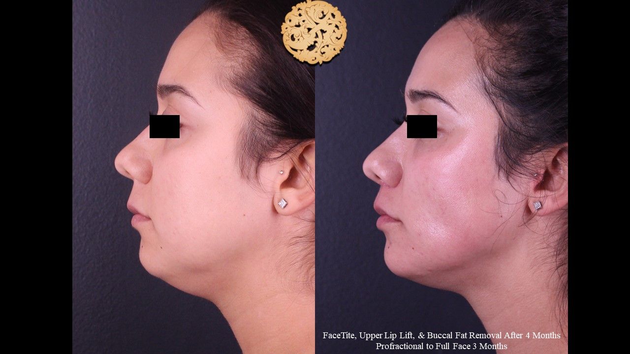 Facetite Before & After