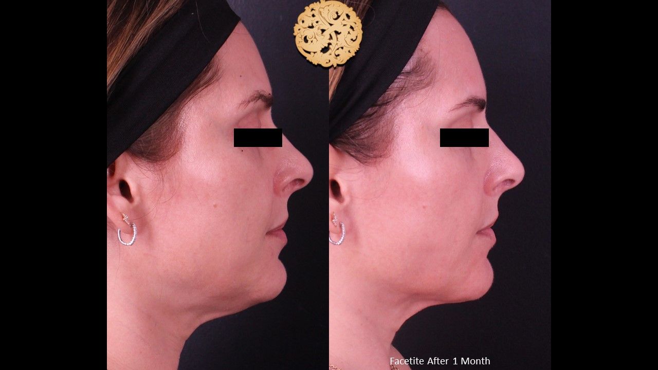 Facetite Before & After