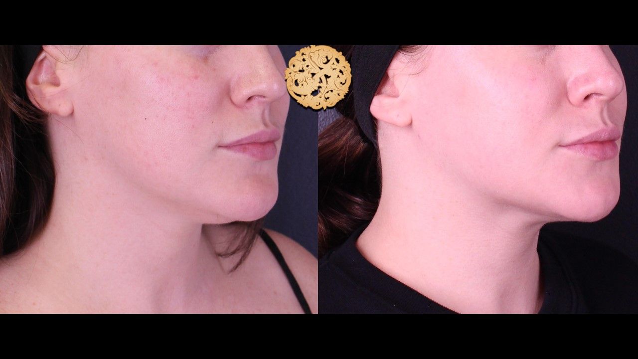 Facetite Before & After