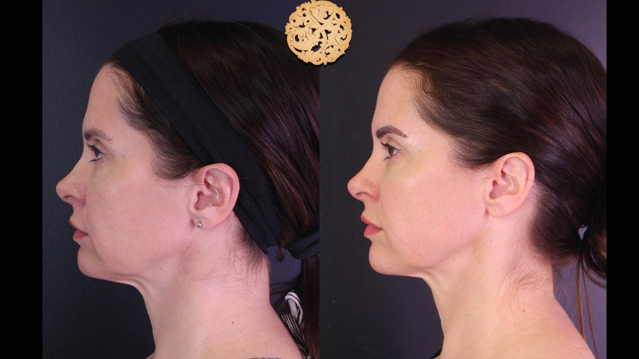 Facetite Before & After