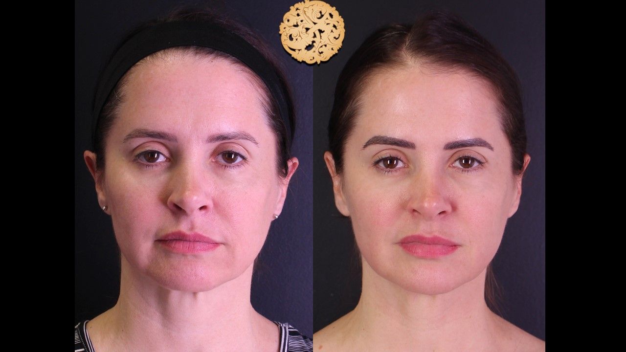 Facetite Before & After