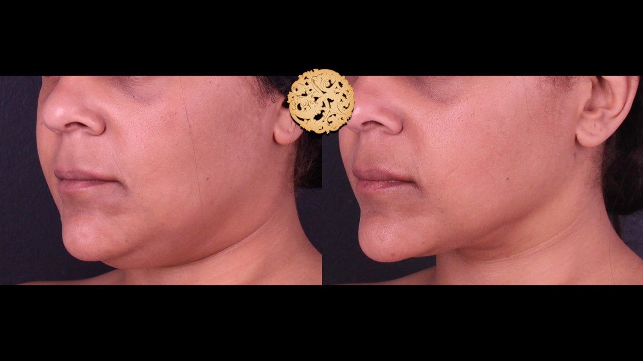 Facetite Before & After