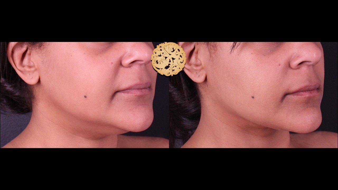 Facetite Before & After