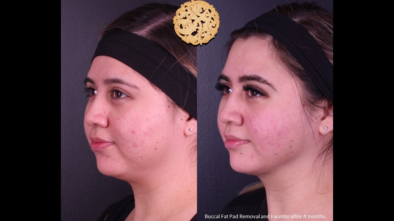 Facetite Before & After