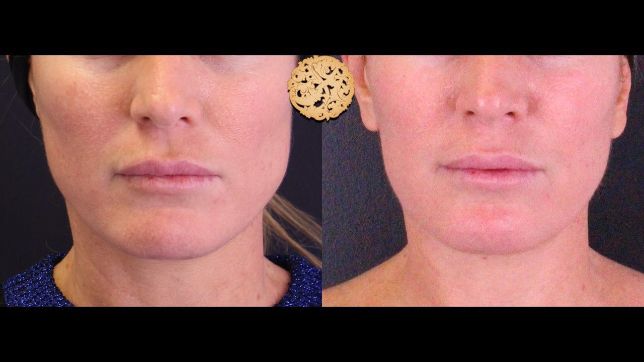 Facetite Before & After