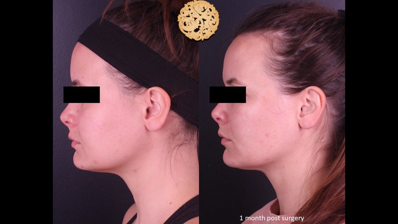 Facetite Before & After