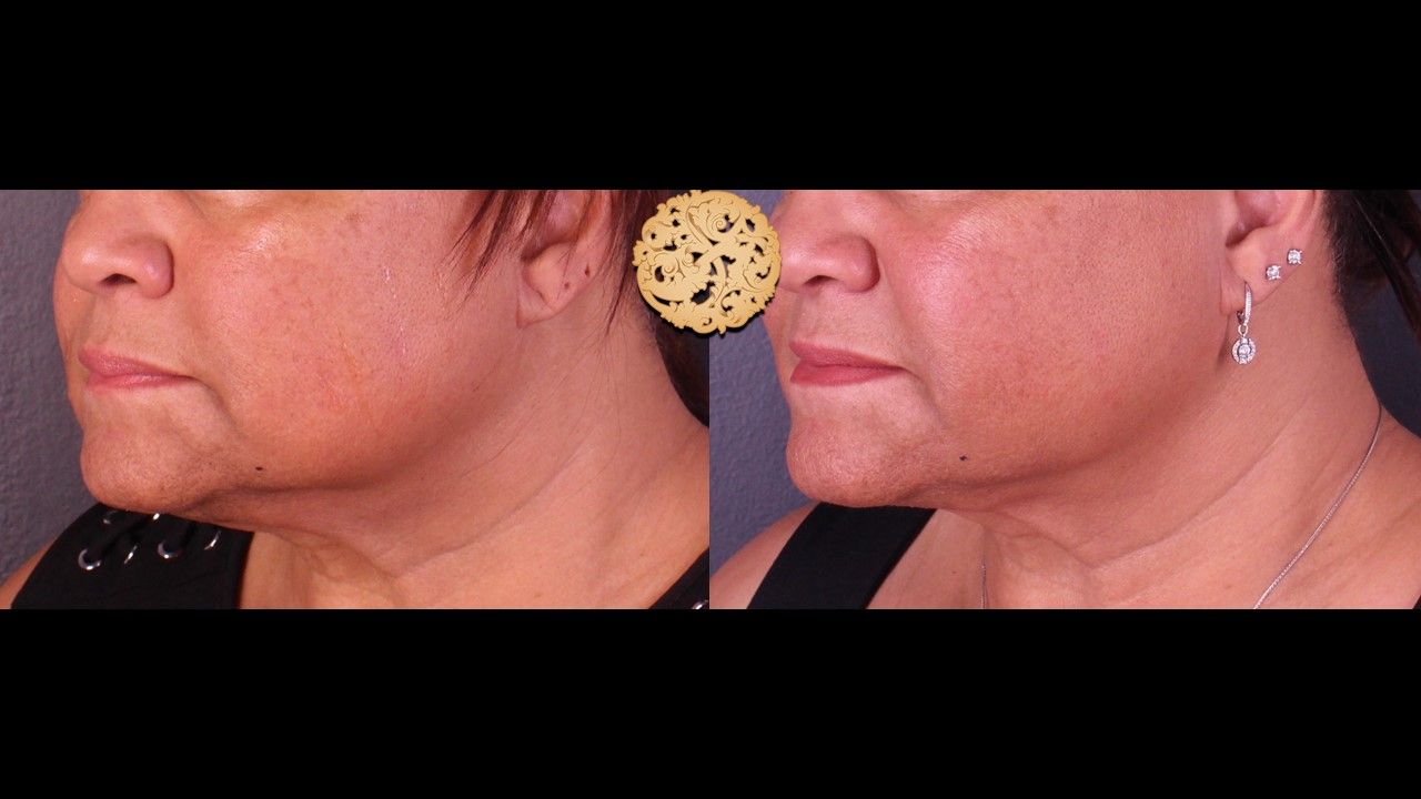 Facetite Before & After