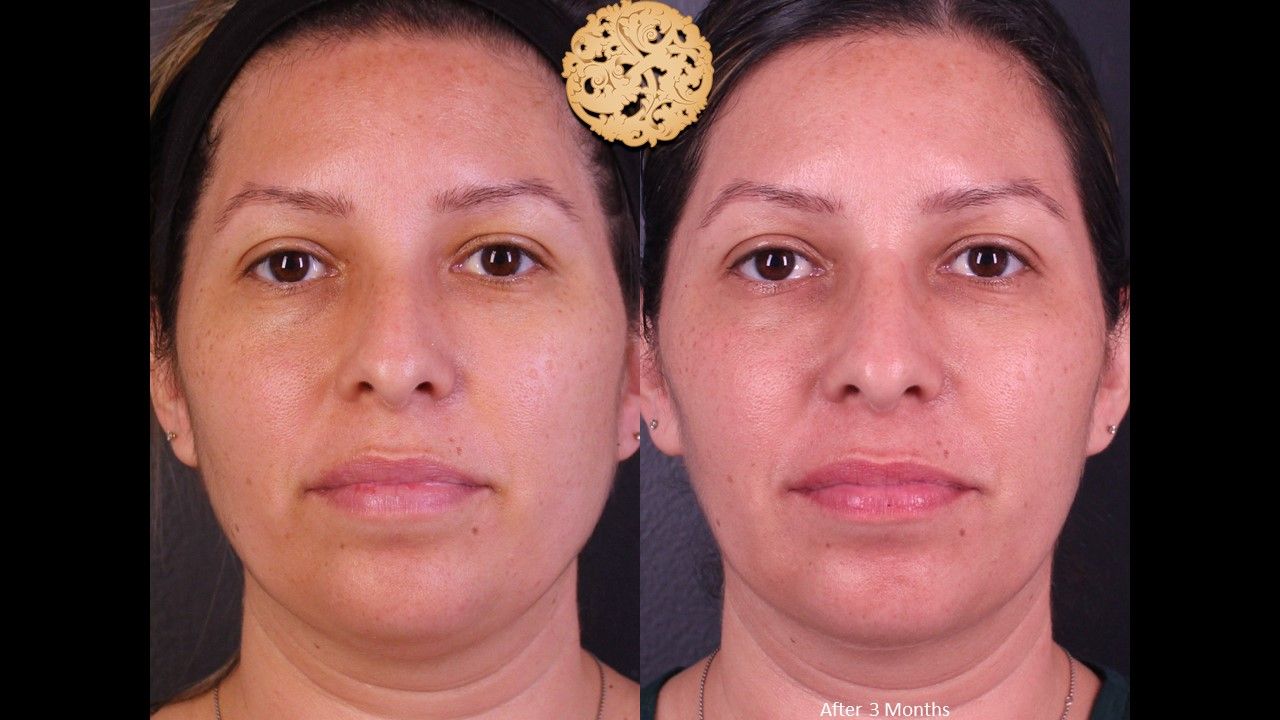 Facetite Before & After
