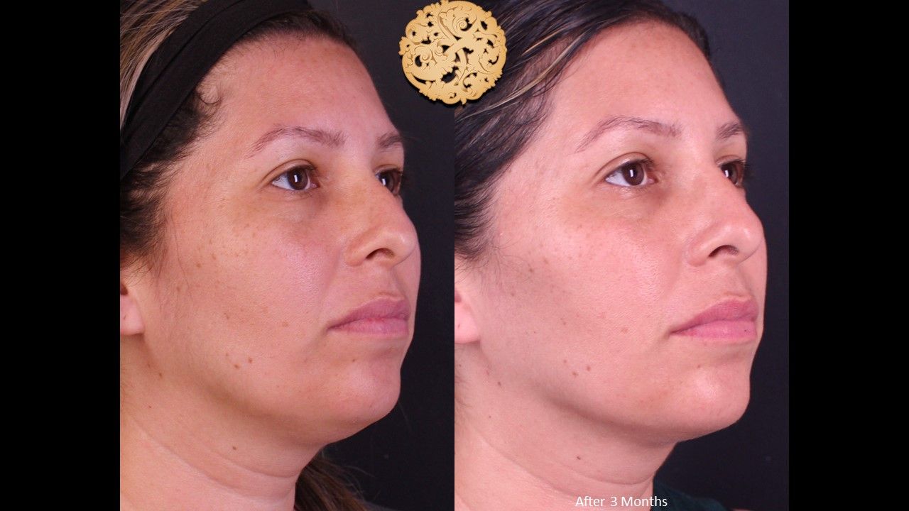 Facetite Before & After