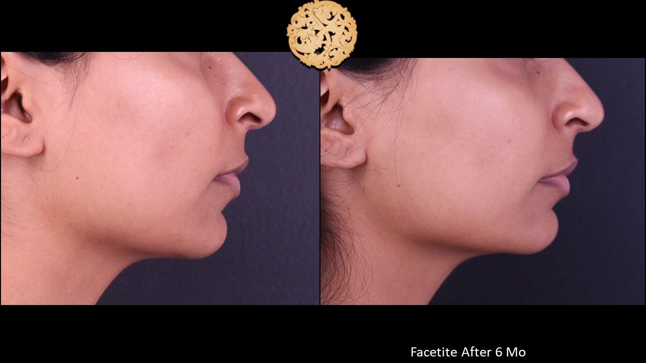 Facetite Before & After