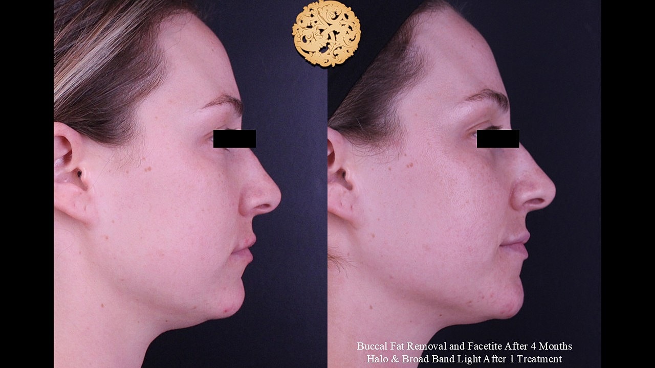 Facetite Before & After