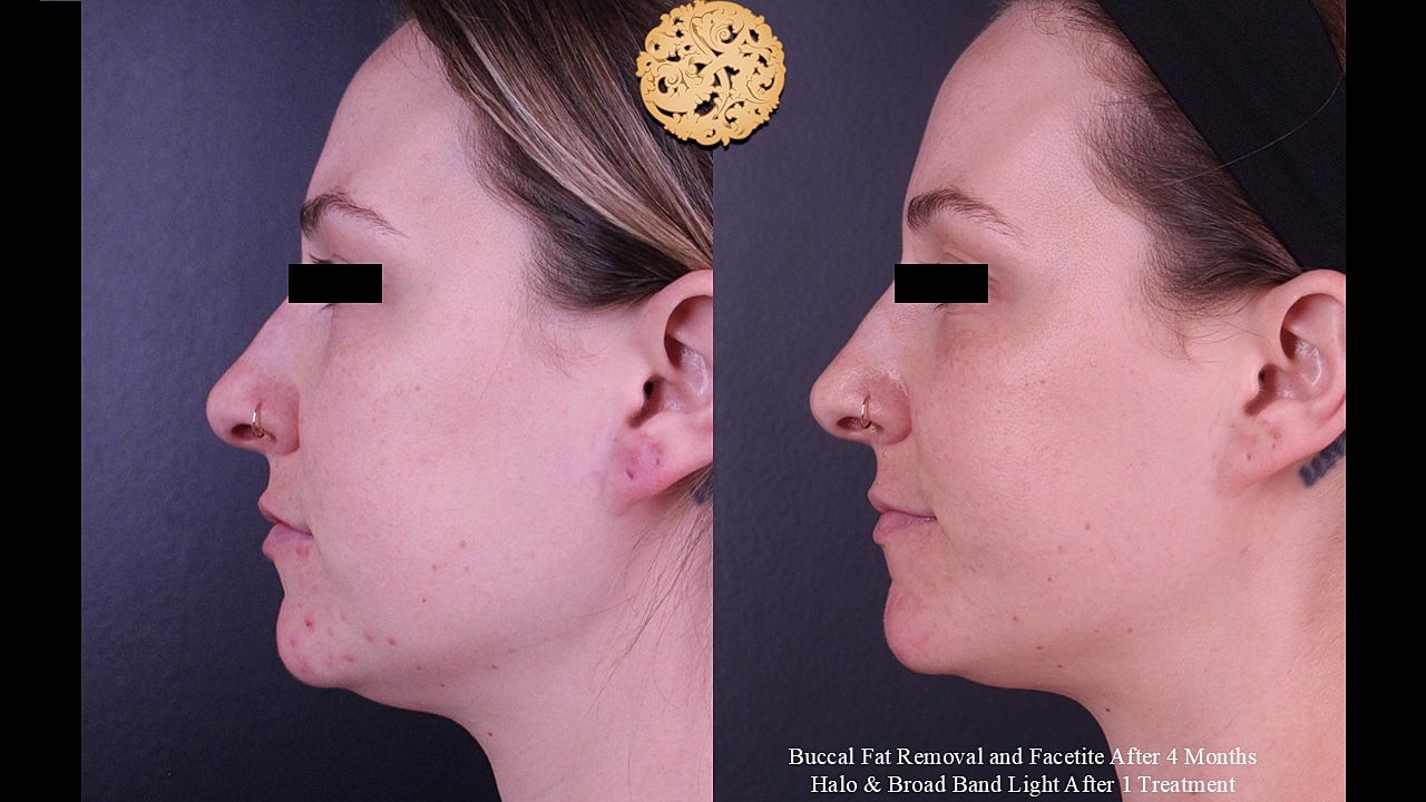 Facetite Before & After