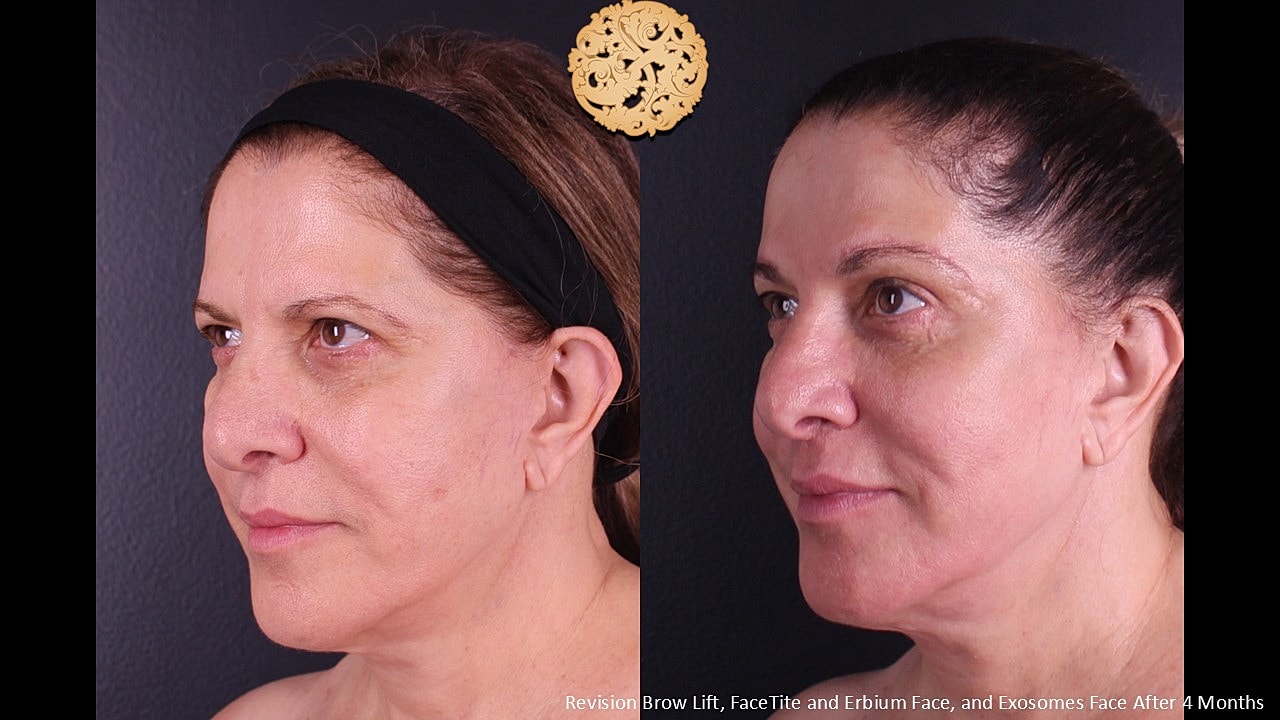 Facetite Before & After