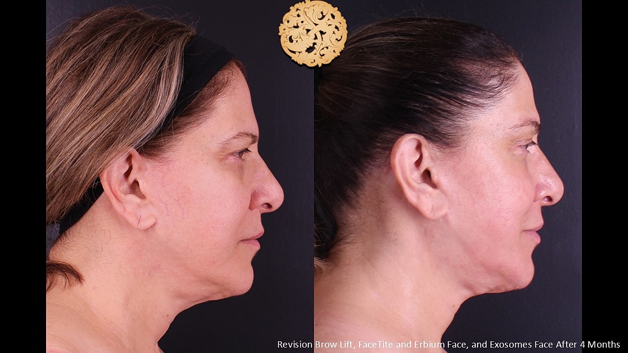 Facetite Before & After