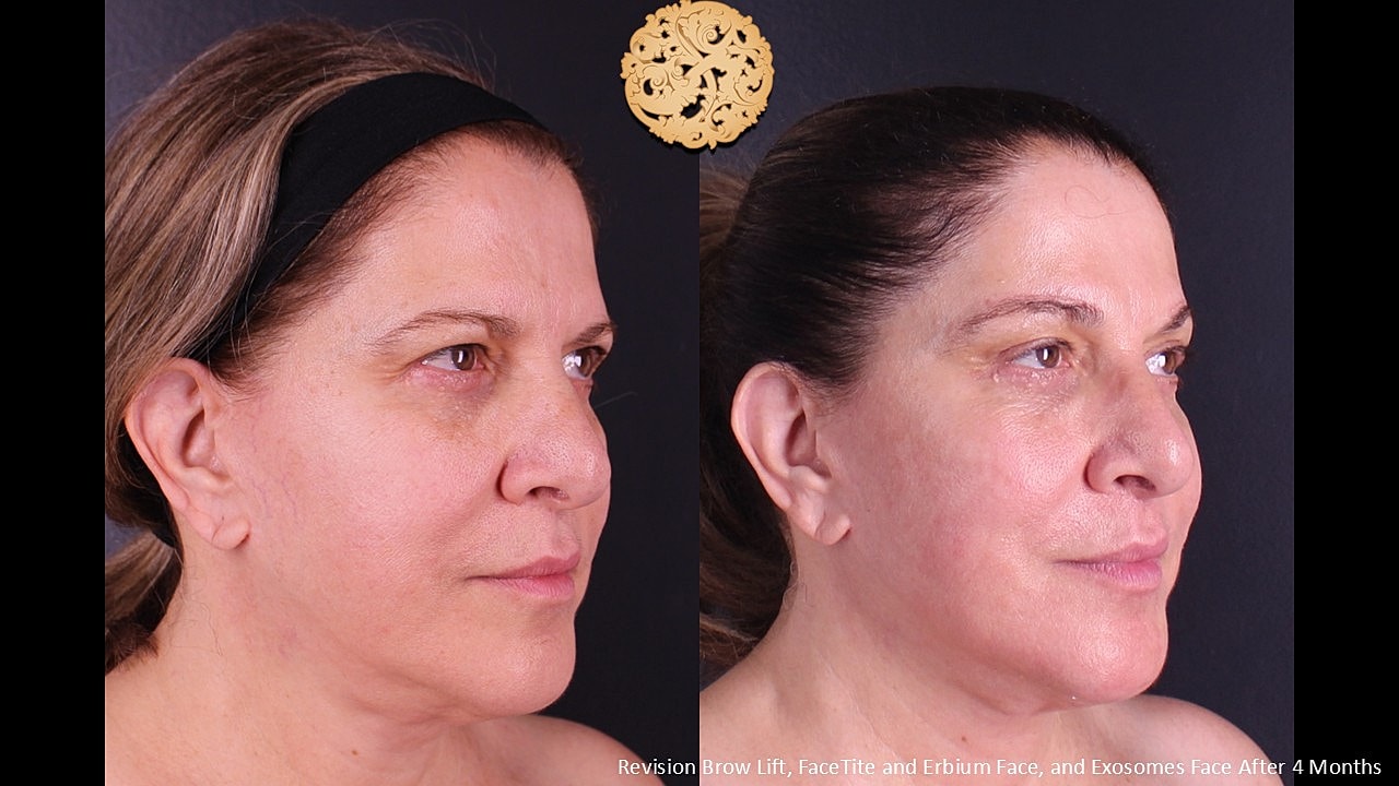 Facetite Before & After