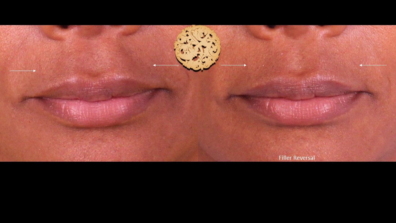 Filler Reversal Before & After