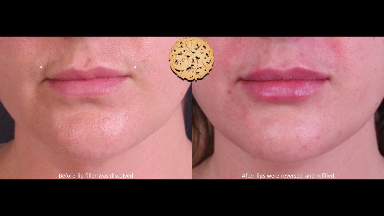 Filler Reversal Before & After