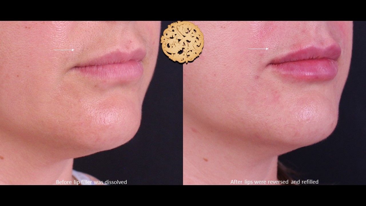 Filler Reversal Before & After