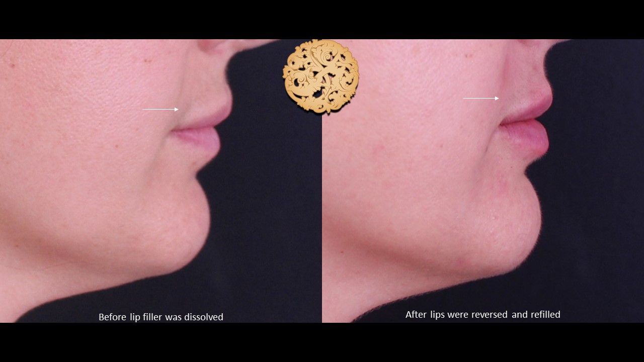 Filler Reversal Before & After