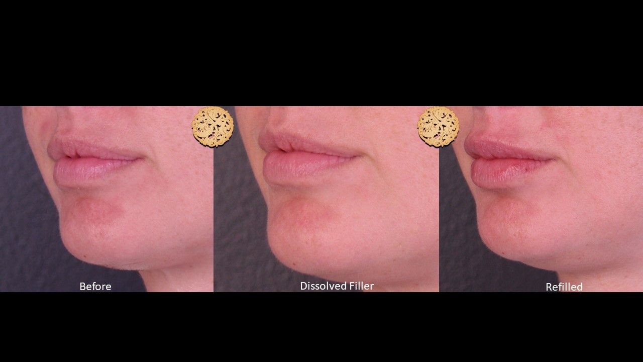 Filler Reversal Before & After
