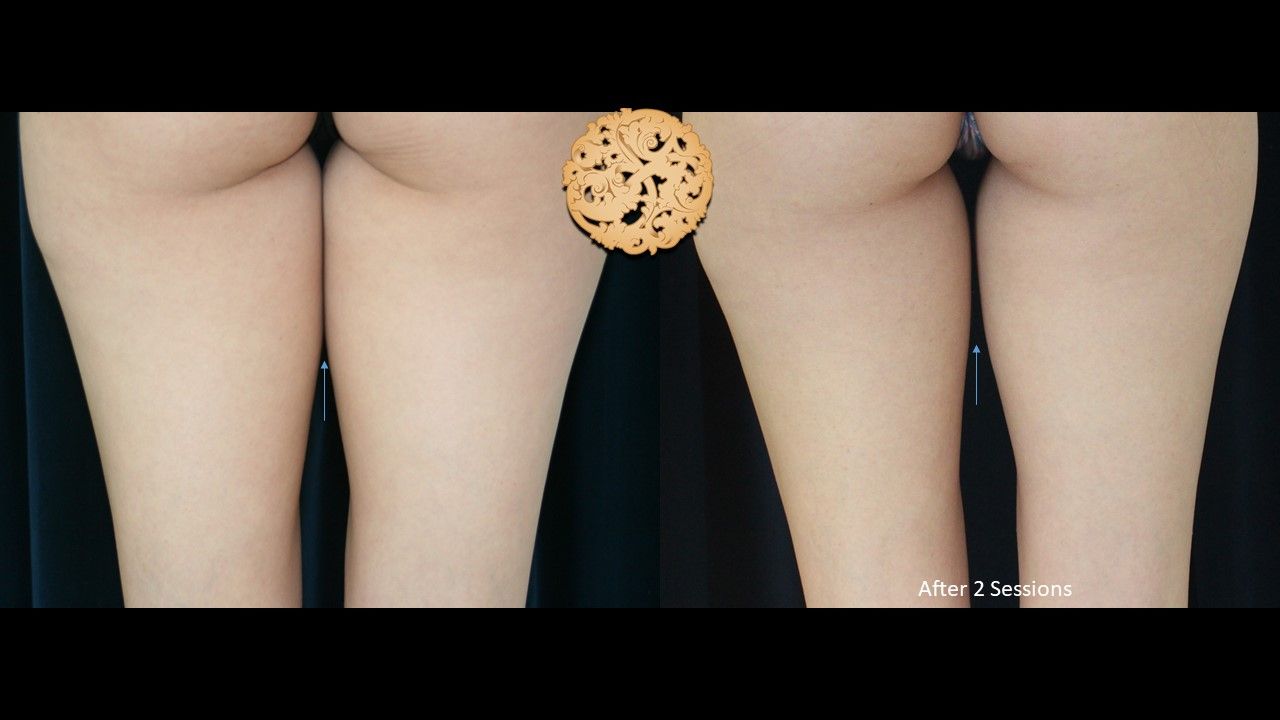 Thigh Coolsculpting Before & After