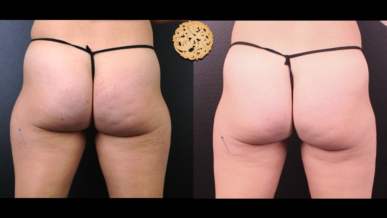 Thigh Coolsculpting Before & After