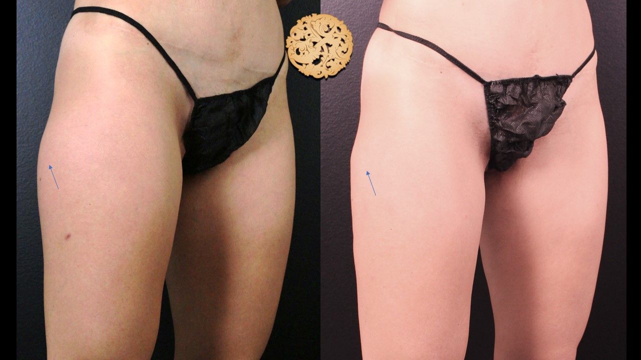 Thigh Coolsculpting Before & After