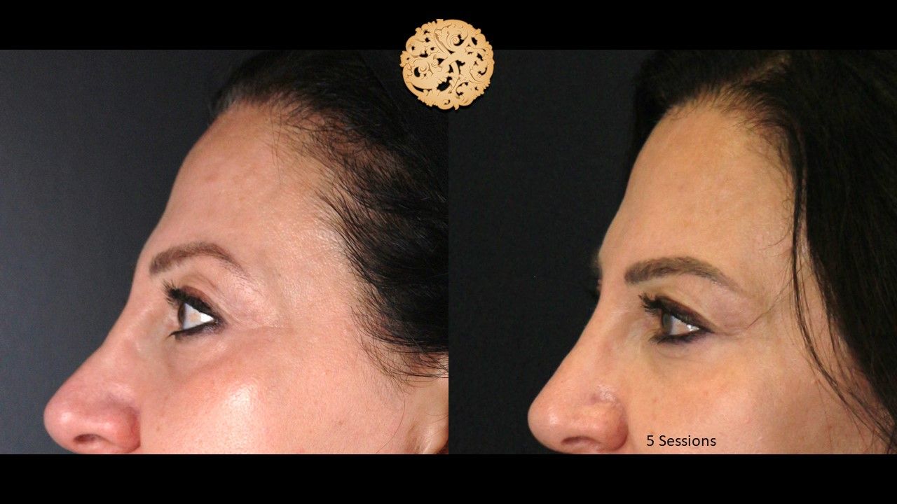 Pelleve Before & After