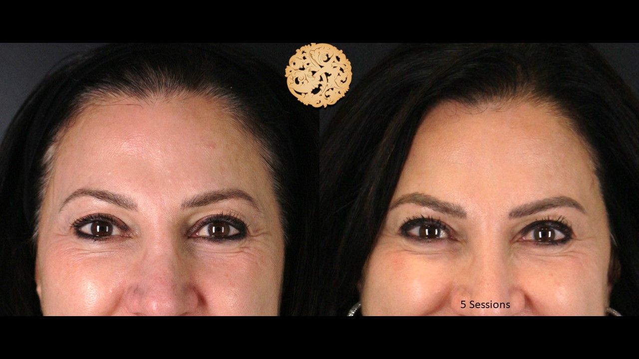 Pelleve Before & After