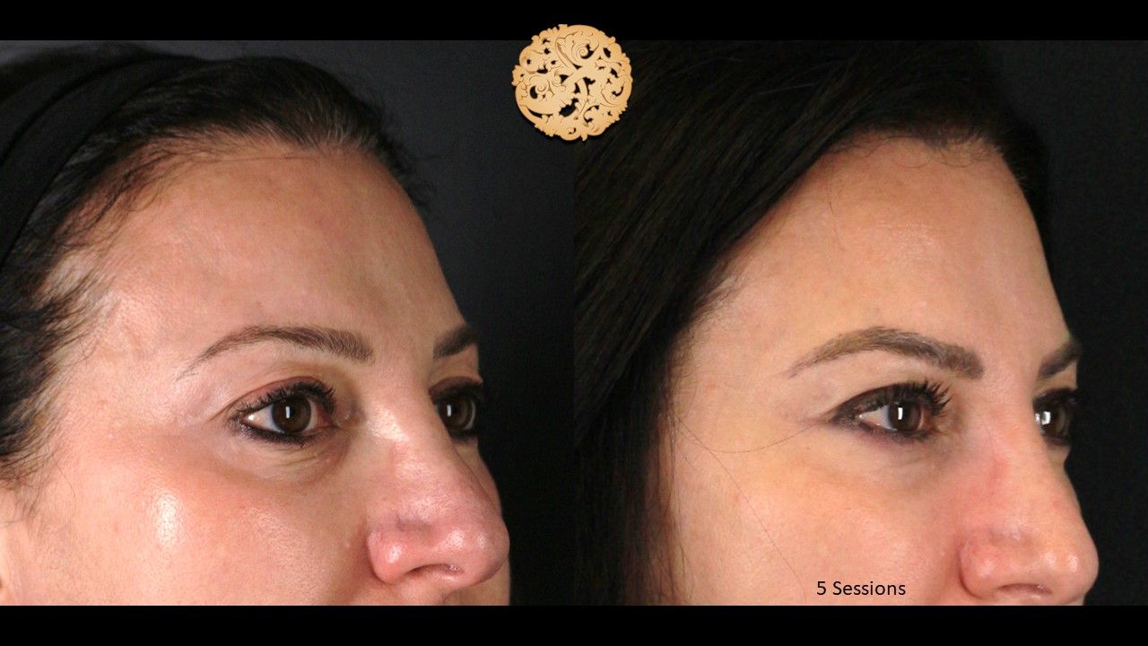 Pelleve Before & After